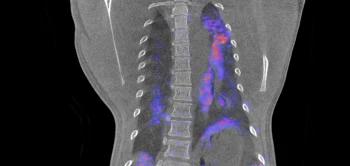 blog petct