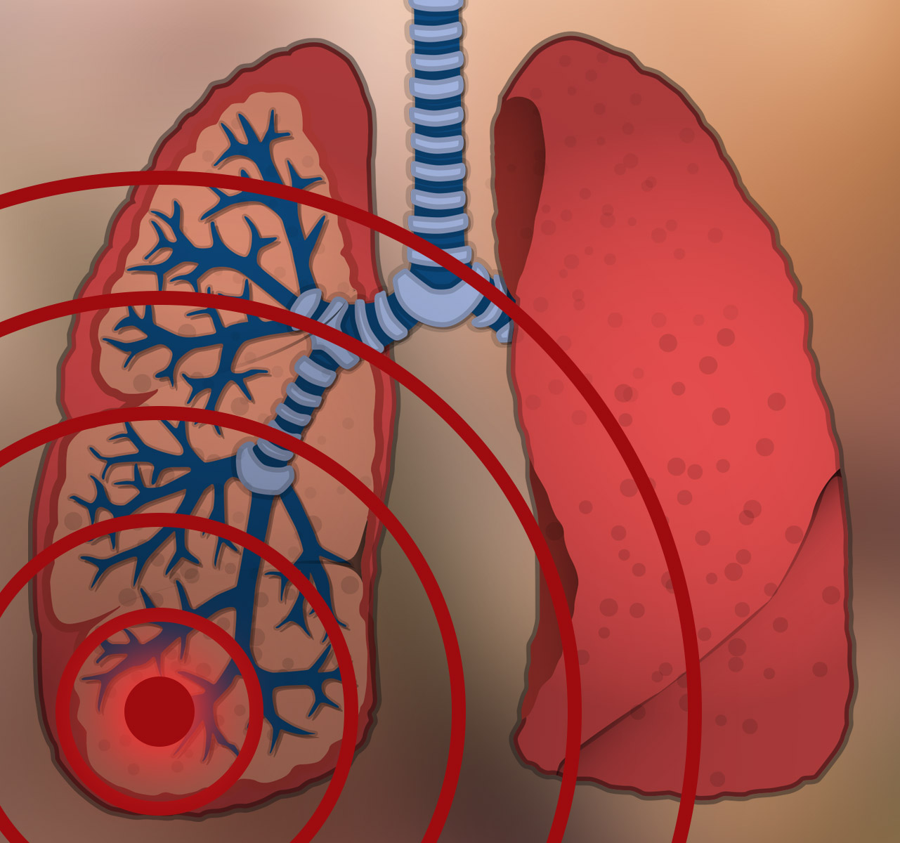 Image Tuberculose